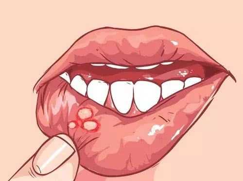 口腔溃疡能抽电子烟吗？只能说影响不大